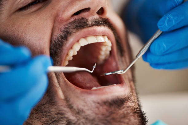 Best Chipped Tooth Repair Near Me  in East Marion, NY